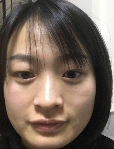 眼袋