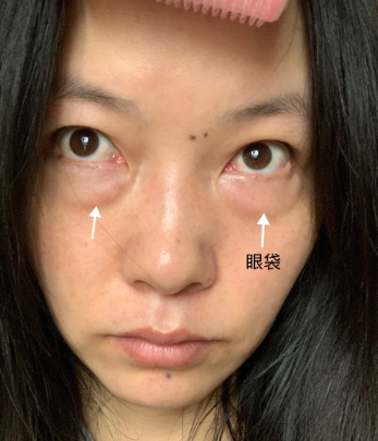 眼袋