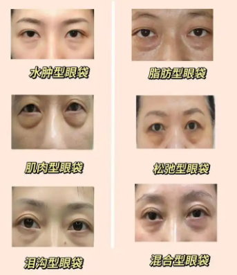 眼袋
