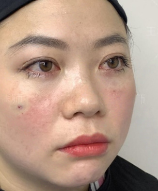去眼袋手术