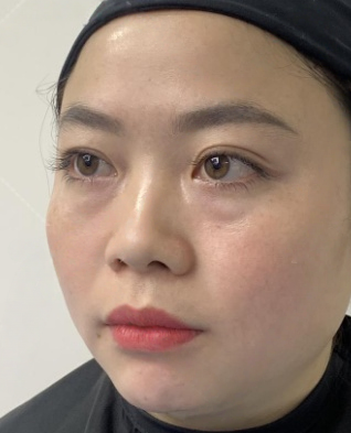 去眼袋手术
