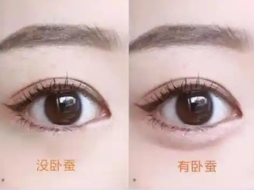 去眼袋手术