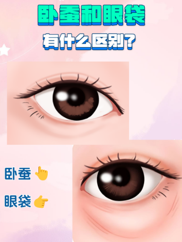 去眼袋手术