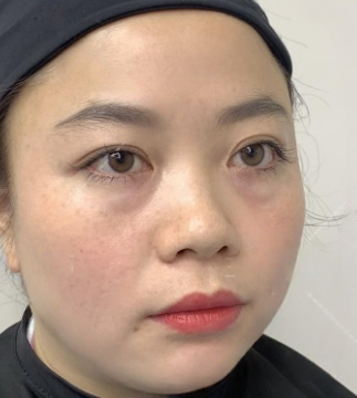 去眼袋手术
