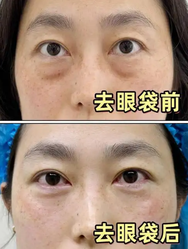 去眼袋手术