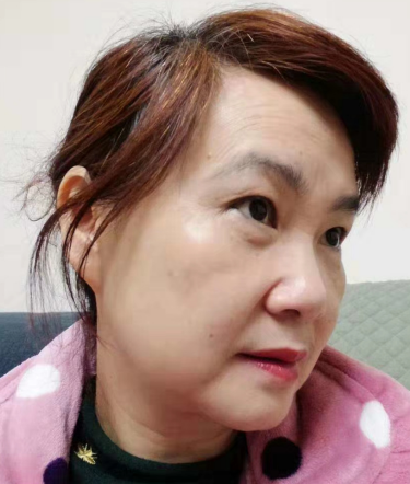 去眼袋手术