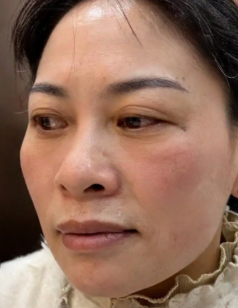 去眼袋手术