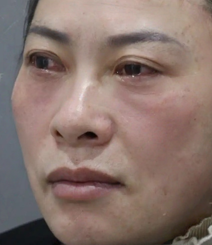 去眼袋手术