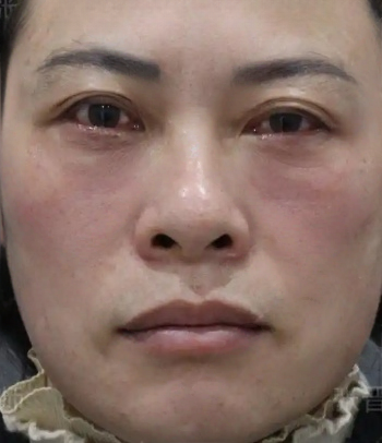 去眼袋手术