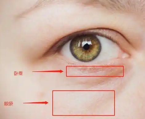 去眼袋手术