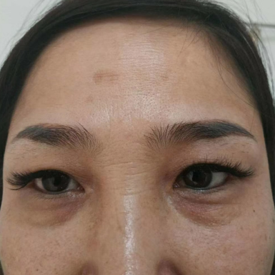 去眼袋手术