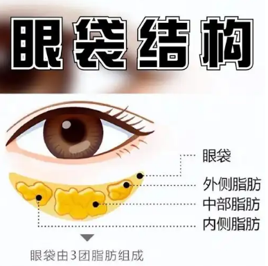 去眼袋手术