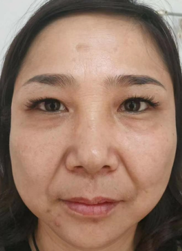 去眼袋手术