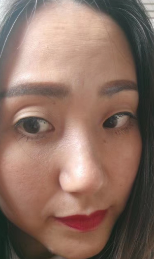 去眼袋手术