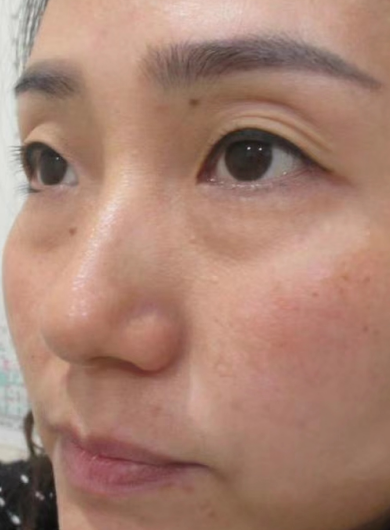 去眼袋手术