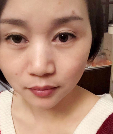 去眼袋手术