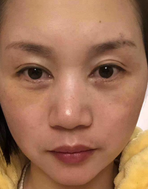 去眼袋手术