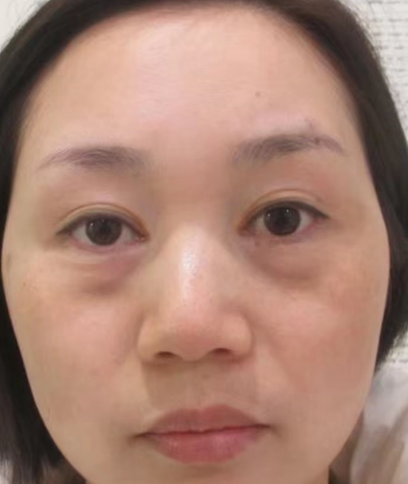 去眼袋手术