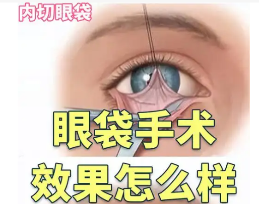 去眼袋手术