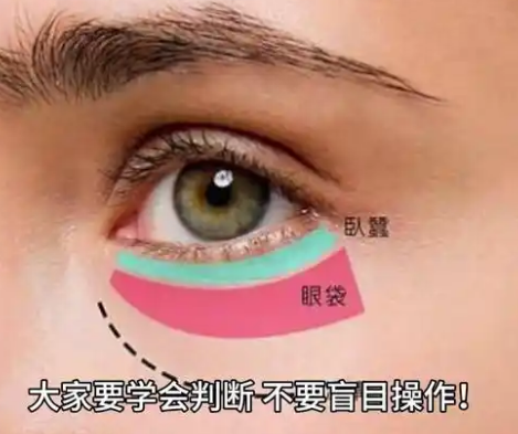 去眼袋手术
