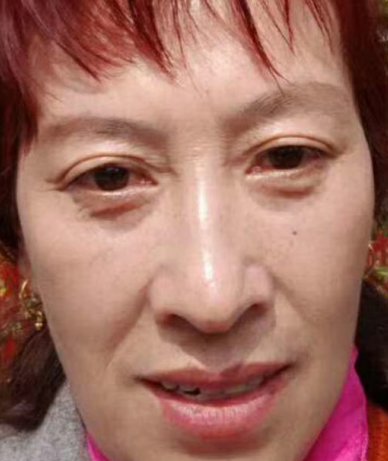 去眼袋手术