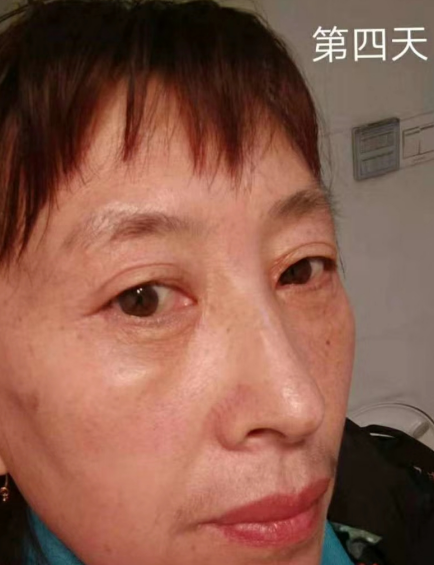 去眼袋手术