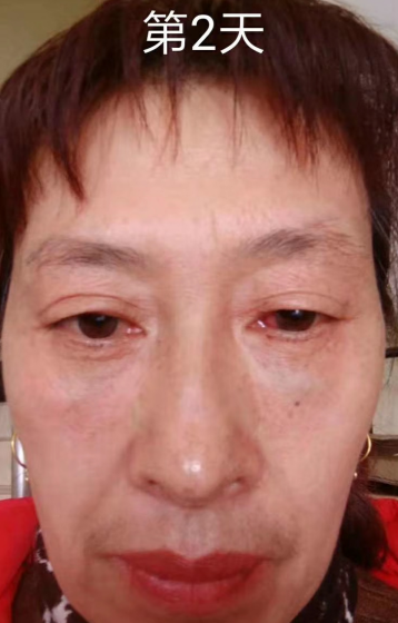 去眼袋手术