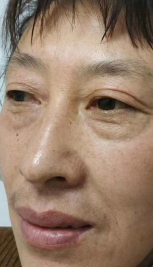 去眼袋手术