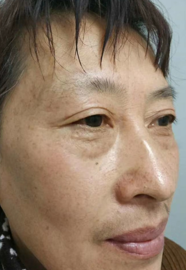 去眼袋手术