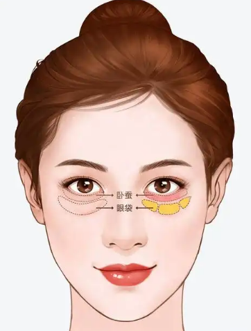 去眼袋手术