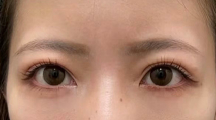 去眼袋手术