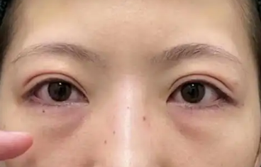 去眼袋手术