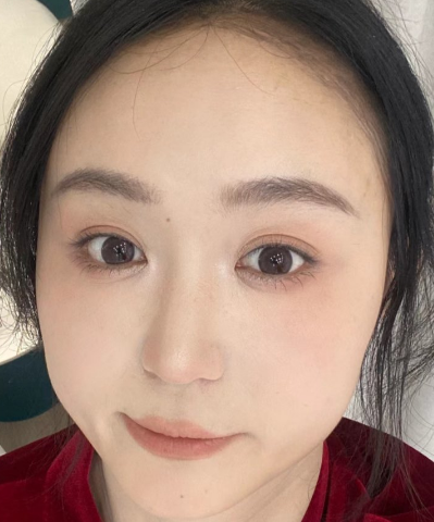 去眼袋手术