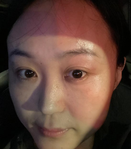 去眼袋手术