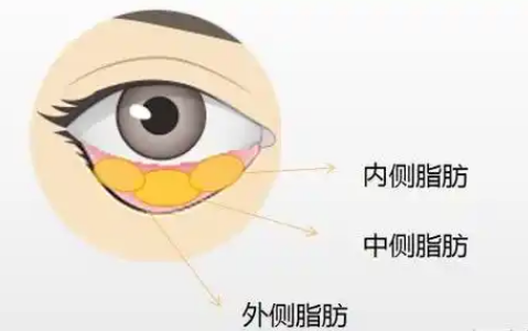 去眼袋手术