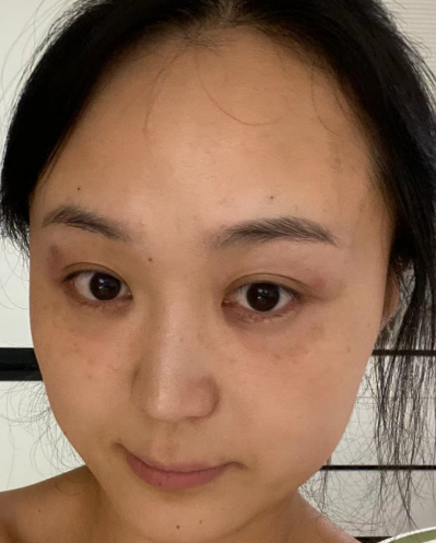 去眼袋手术