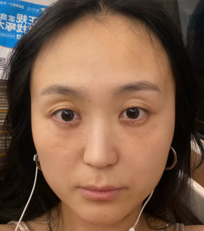 去眼袋手术