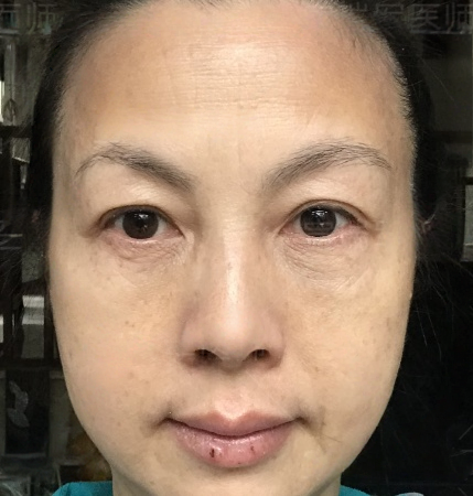 去眼袋手术