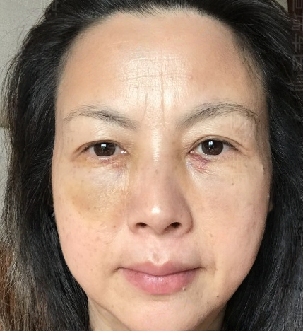 去眼袋手术