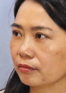 去眼袋手术