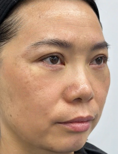 去眼袋手术