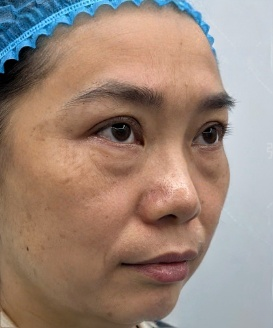 去眼袋手术