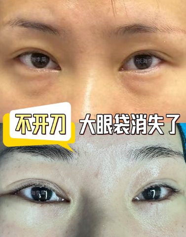 眼袋