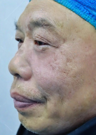 去眼袋手术