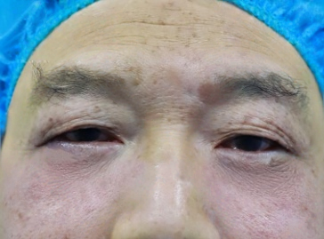 去眼袋手术