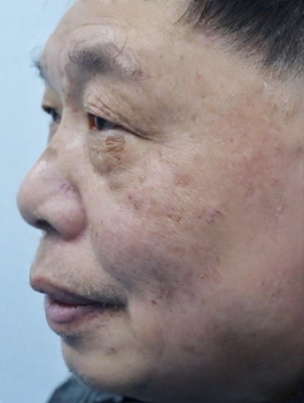 去眼袋手术