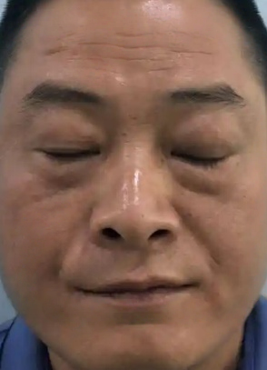 去眼袋手术
