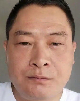 去眼袋手术