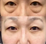 去眼袋手术