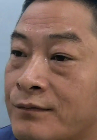 去眼袋手术